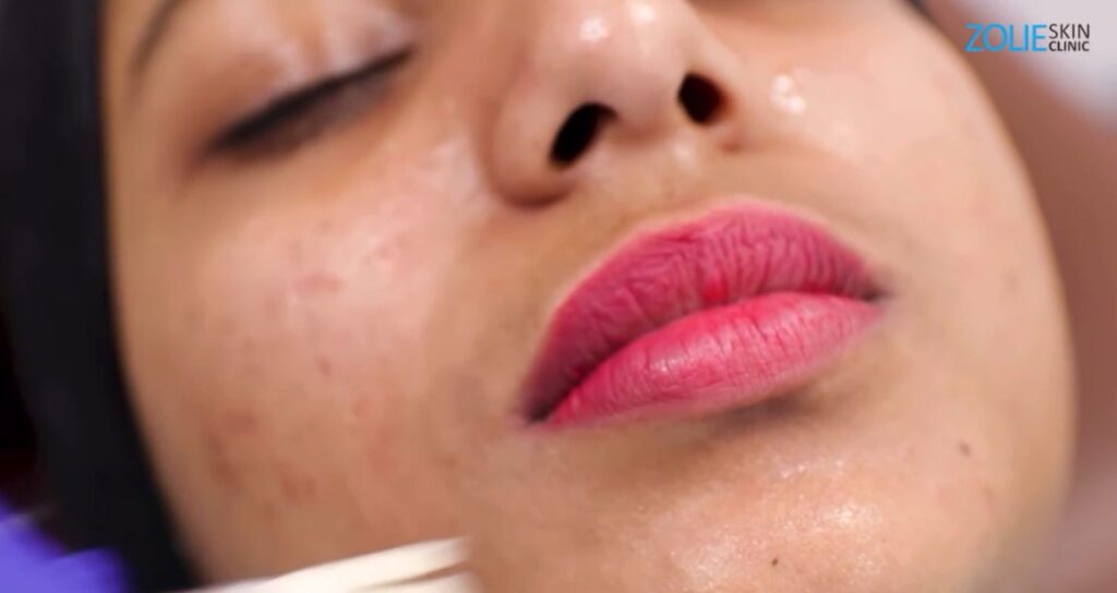 Why Go In For A Chemical Peel?